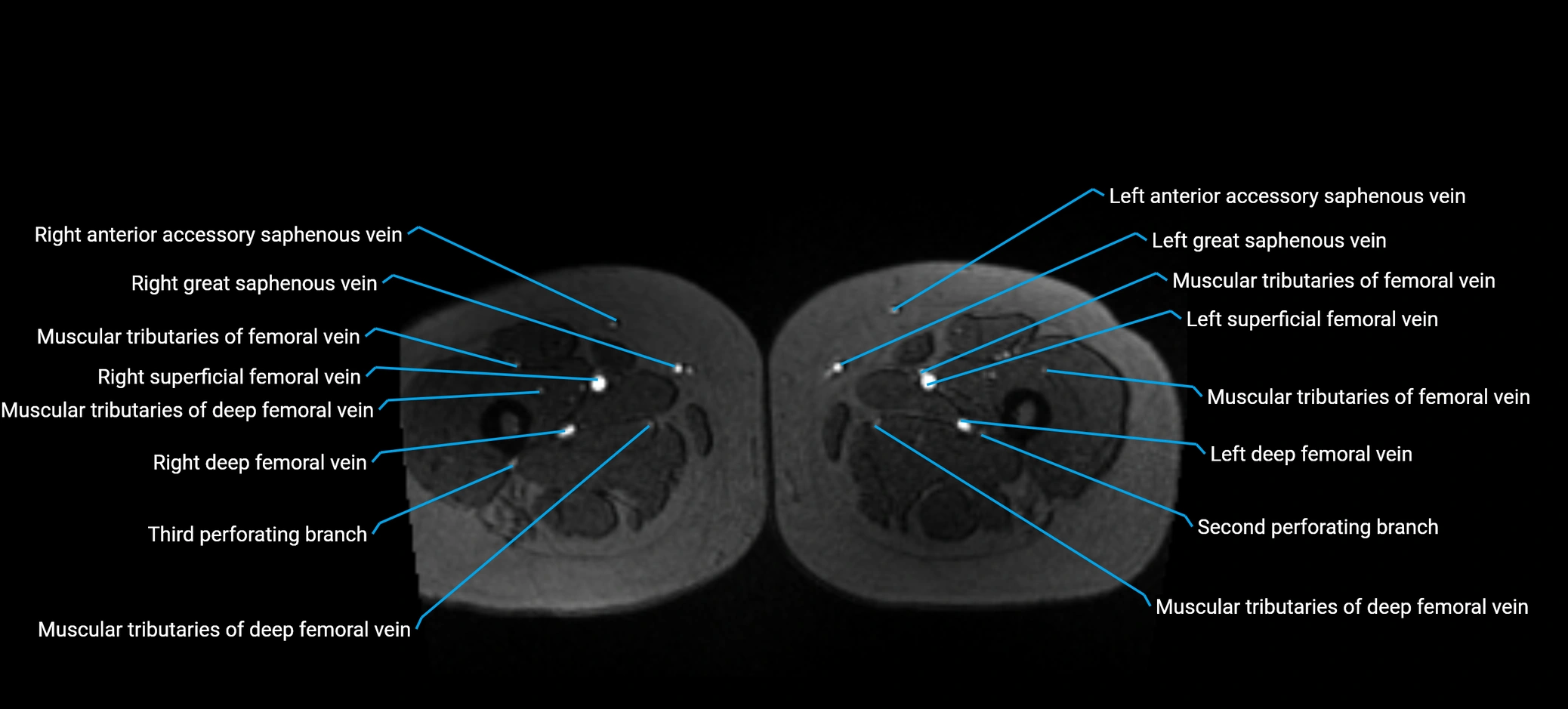 MRV abdomen pelvis & lower limb axial cross sectional anatomy labelled MRI image 245 (1).webp